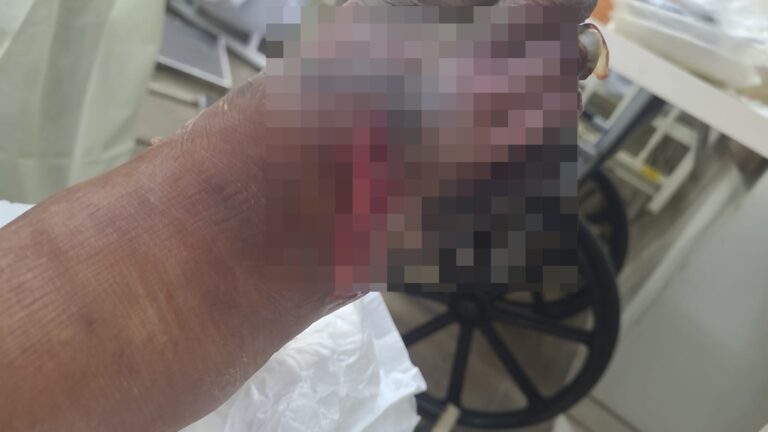 Mulher de 70 anos com pé necrosado corre risco de amputação no DF Mulher de 70 anos com pé necrosado corre risco de amputação no DF